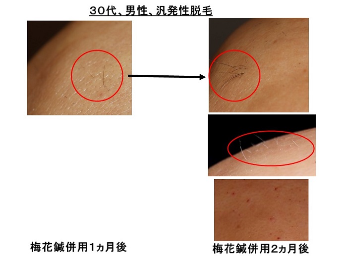 円形脱毛症　病院